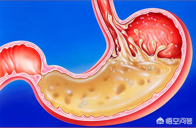 胃不好有什么癥狀?胃病常見病因及癥狀是什么?該如何治療和護理<strong>胃病</strong>？