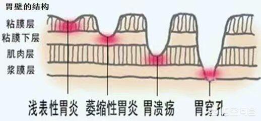 胃不好有什么癥狀?胃病常見病因及癥狀是什么?該如何治療和護理<strong>胃病</strong>？